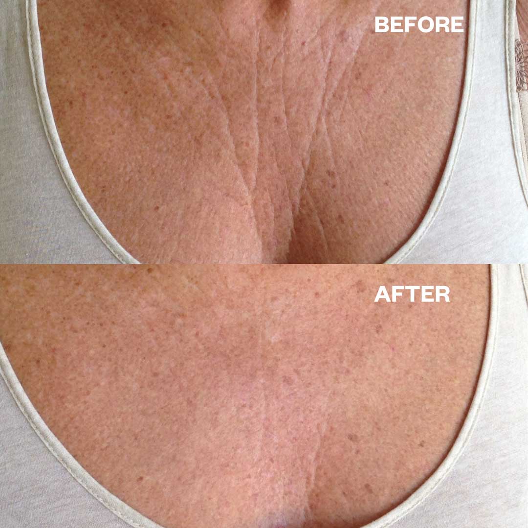 Chest Wrinkle Patch - Image 3