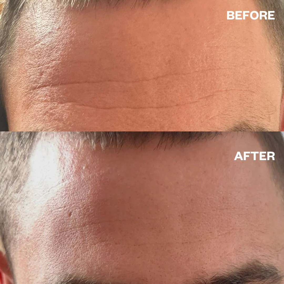 Men's Pro Forehead Wrinkle Patch - Image 5