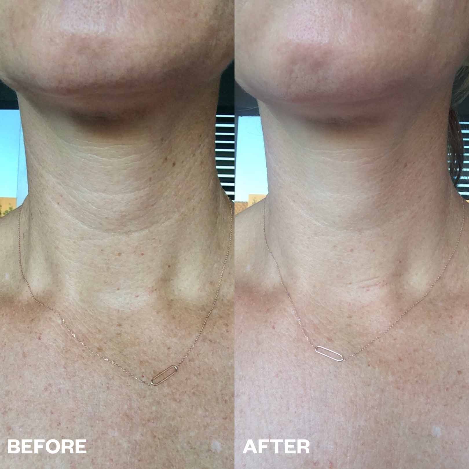 Neck Wrinkle Patch - Image 4
